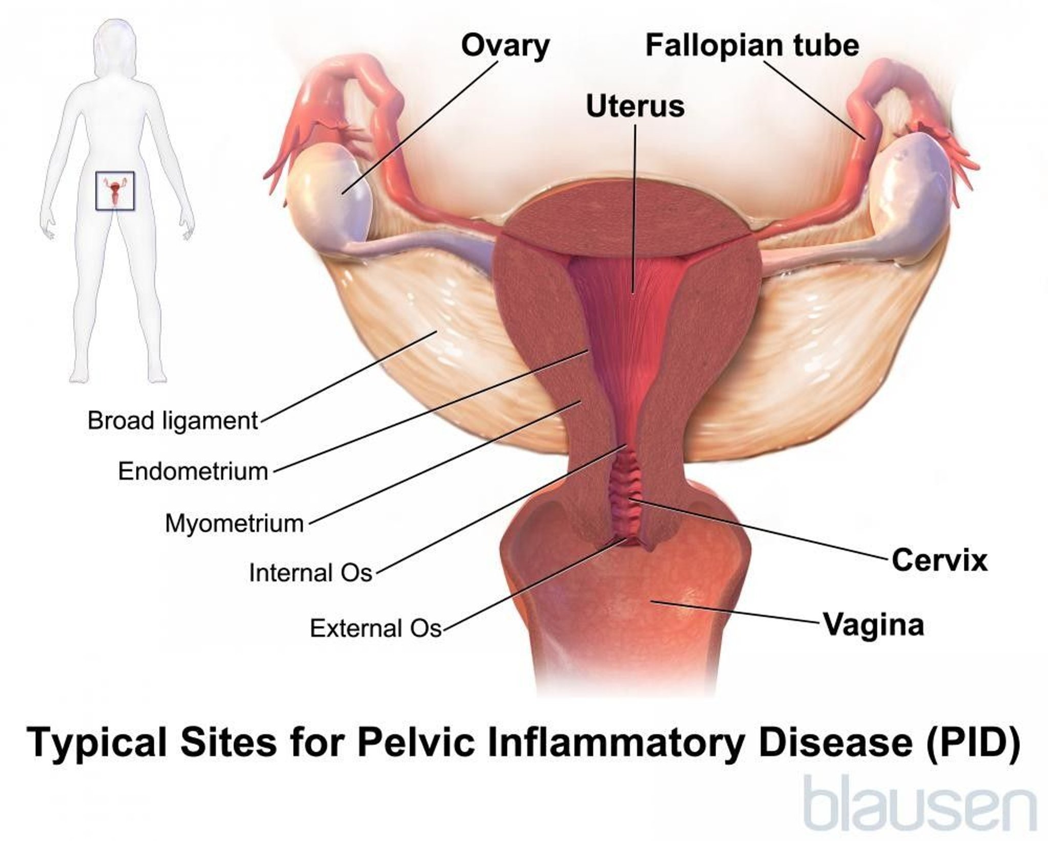 Typical Sites for Pelvic Inflammatory Disease