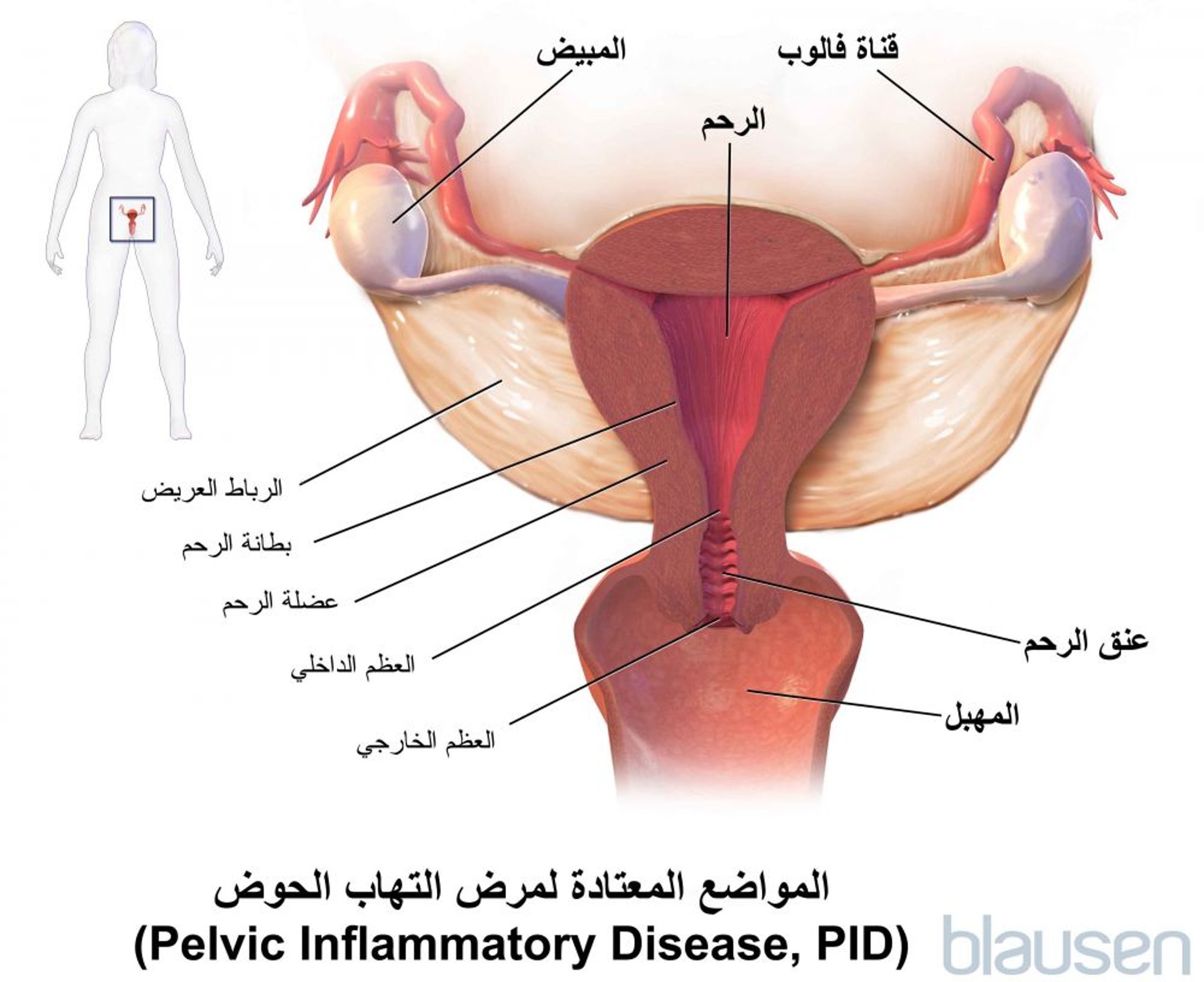 المواقع الاعتيادية للداء الحوضي الالتهابي