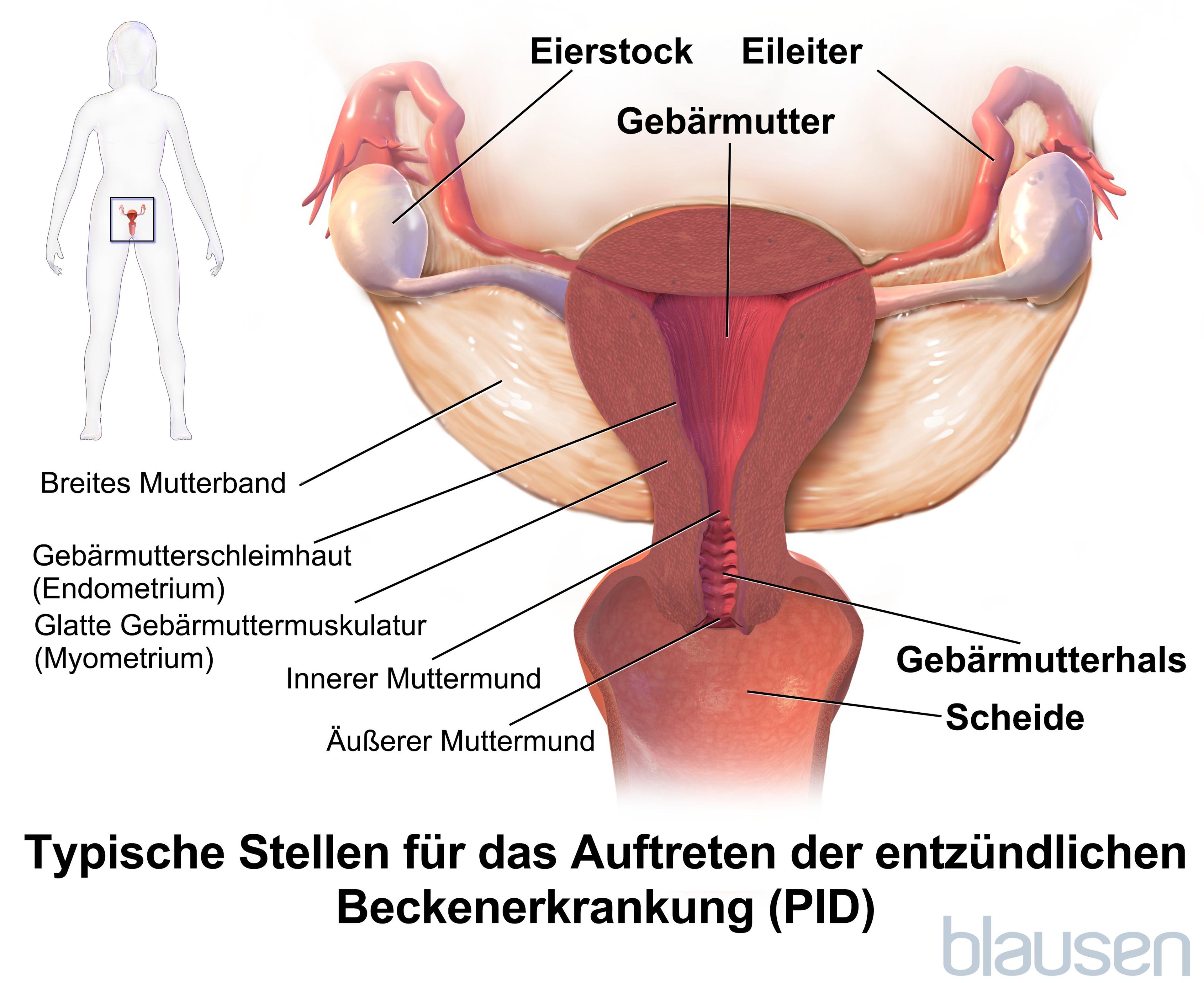 Typische Stellen für das Auftreten der Beckenentzündung