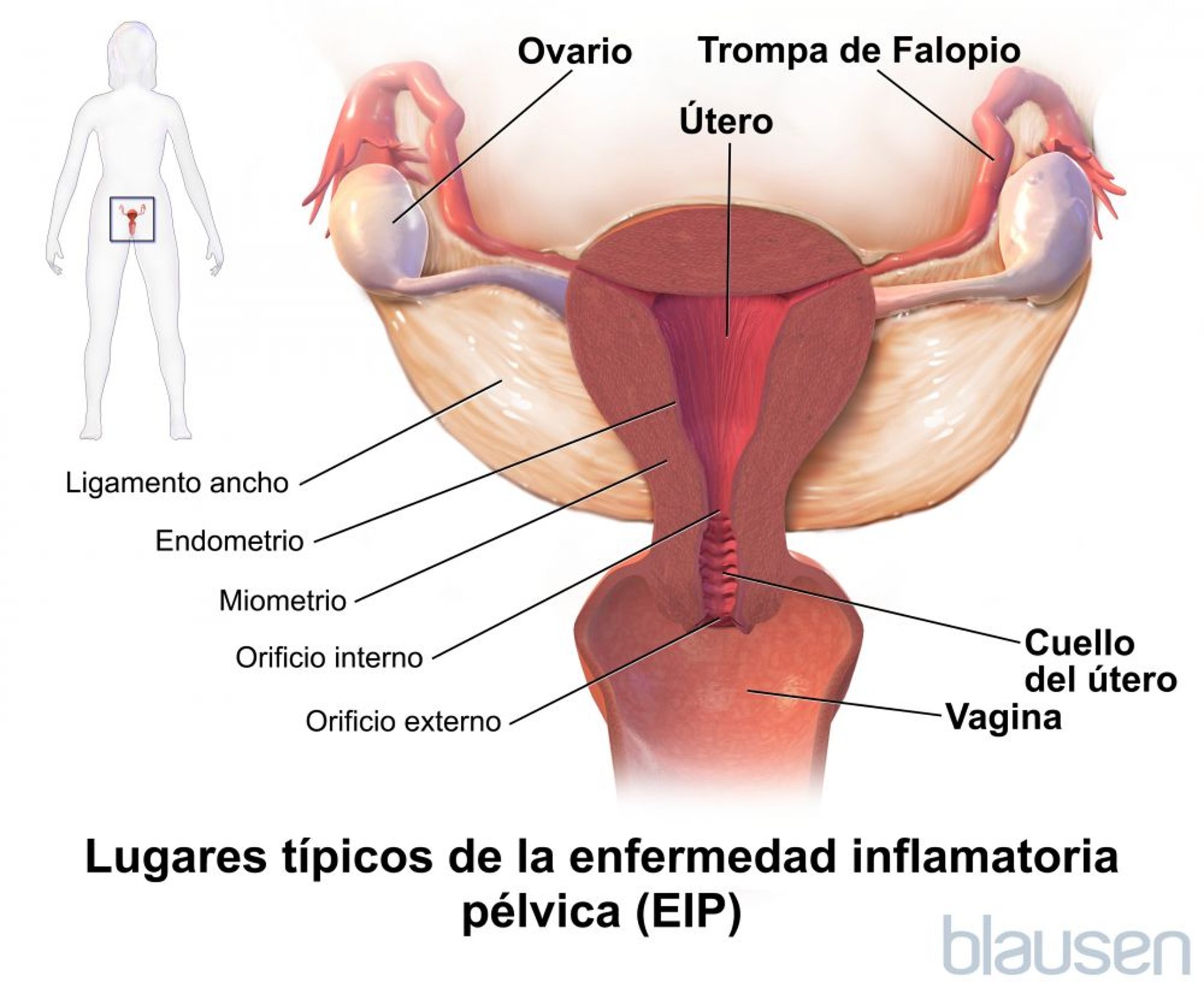 Lugares característicos de la enfermedad inflamatoria pélvica