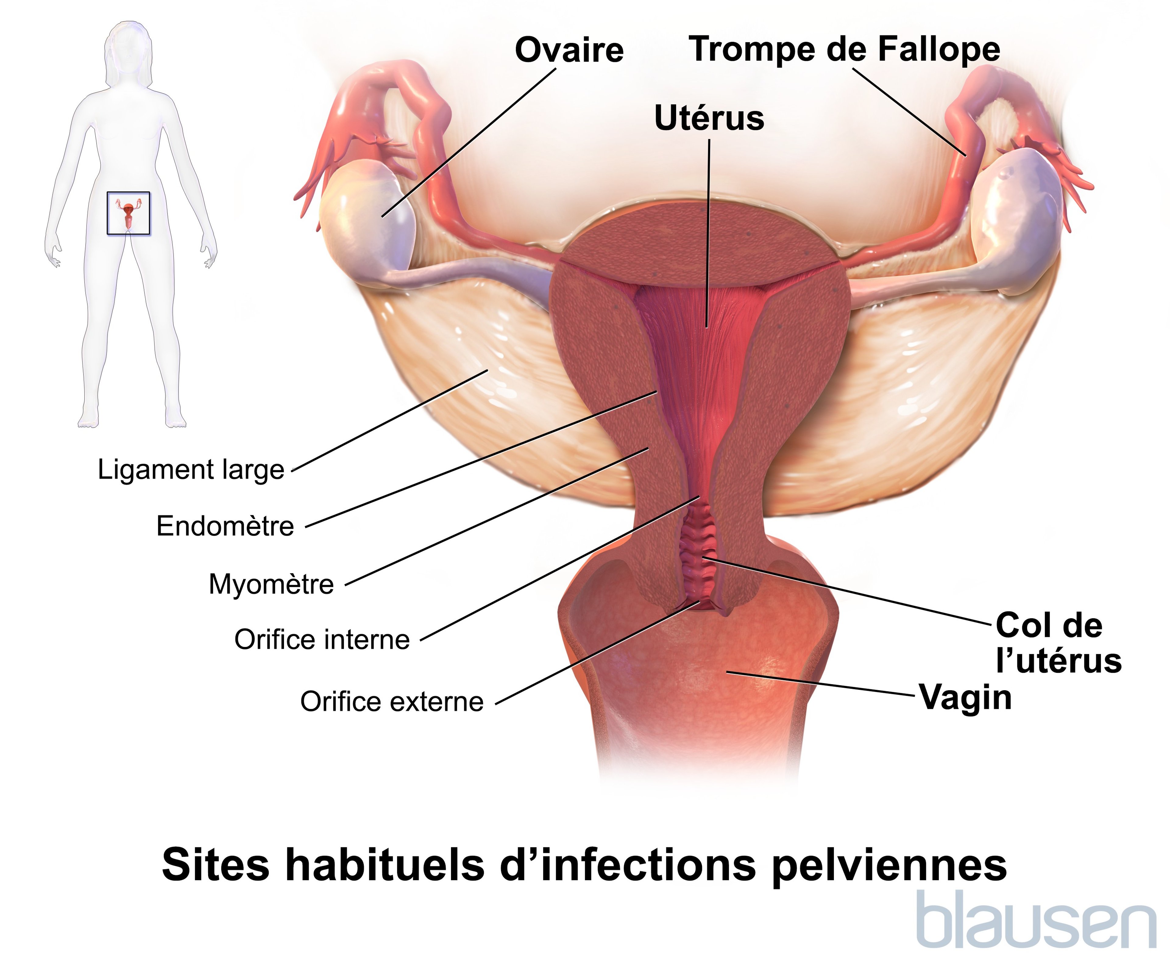 Sites caractéristiques d’une maladie pelvienne inflammatoire