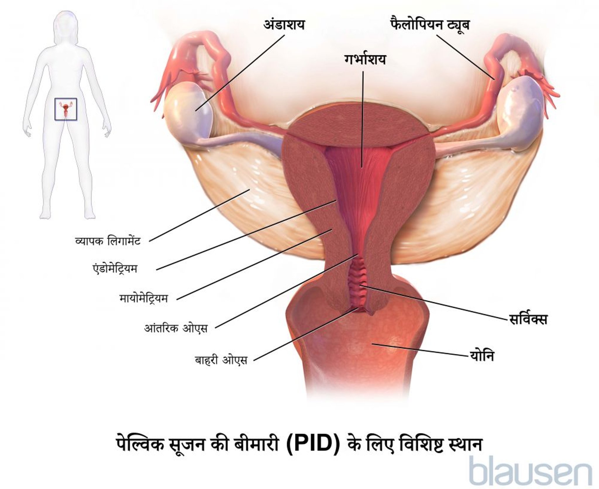 पेल्विक सूजन की बीमारी के लिए विशिष्ट स्थान।