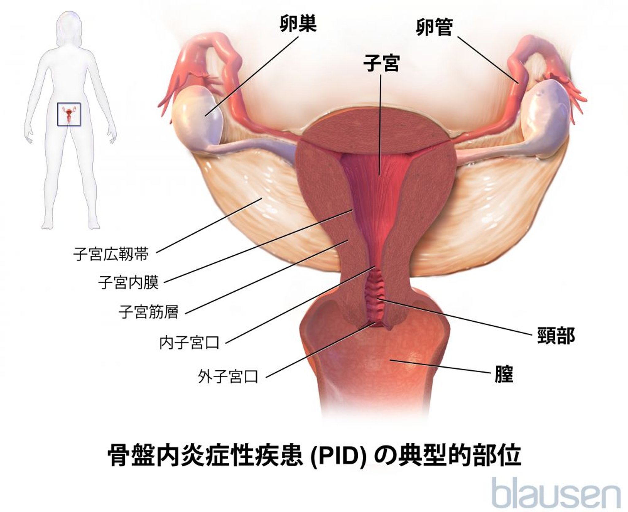 骨盤内炎症性疾患の一般的な発生部位