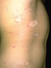 Pityriasis rosé