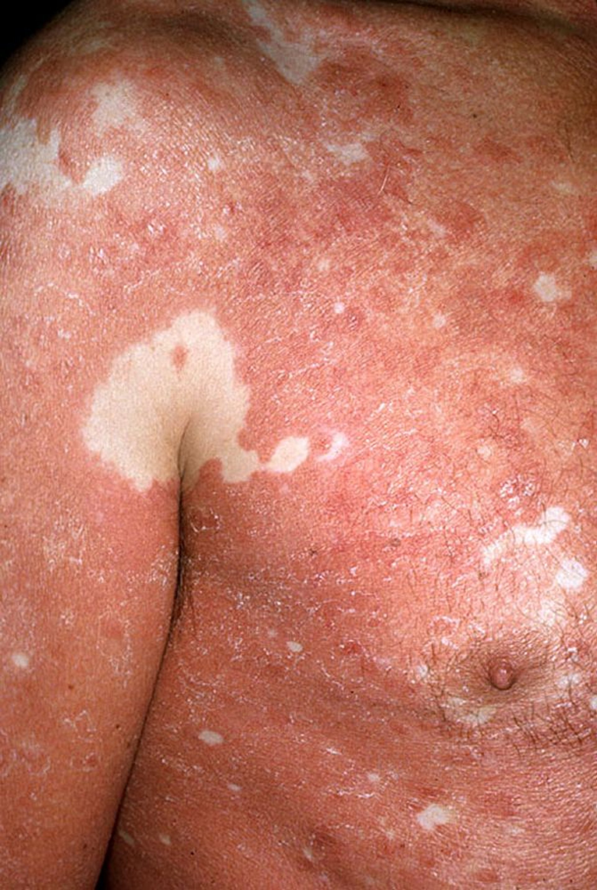 毛孔性紅色粃糠疹（うろこ状の局面）