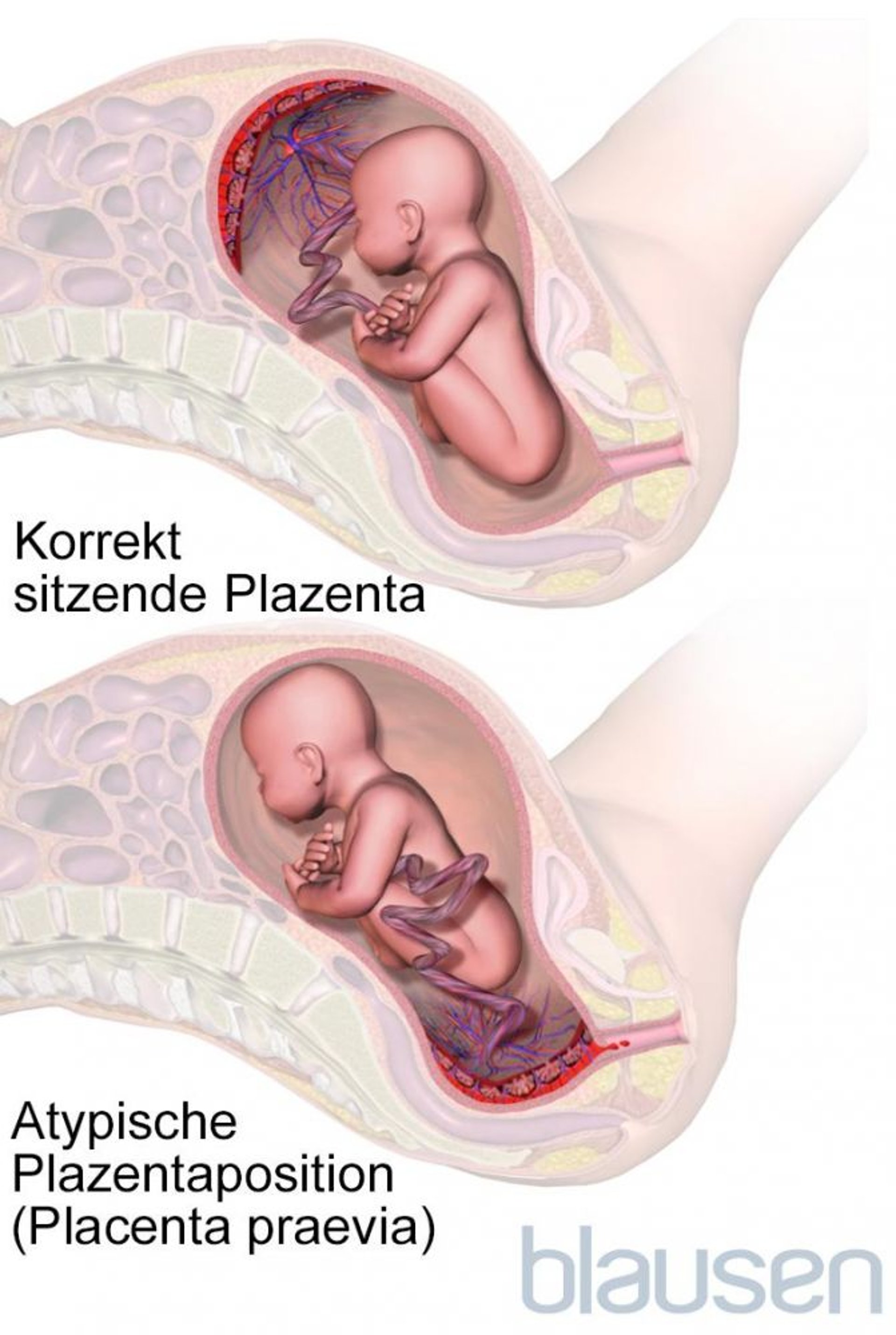 Placenta praevia
