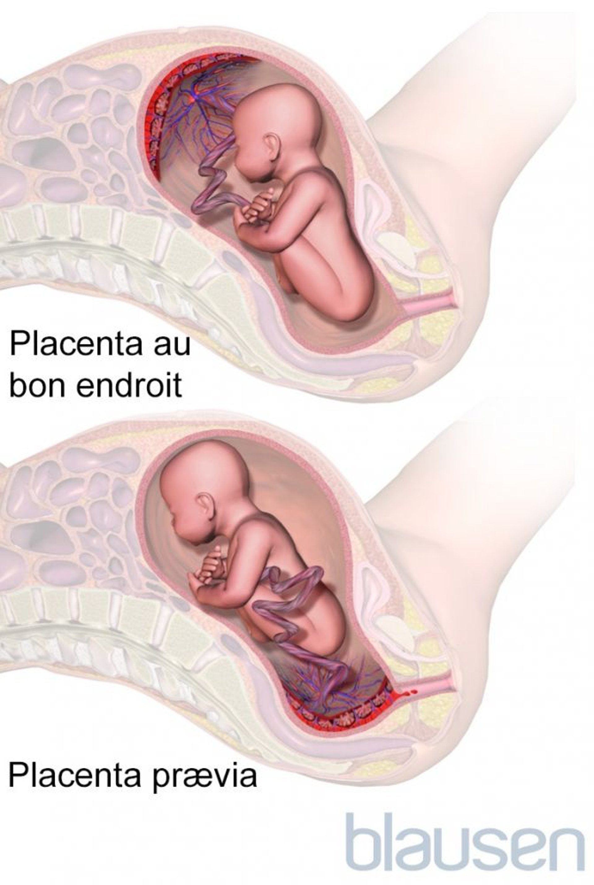 Placenta prævia