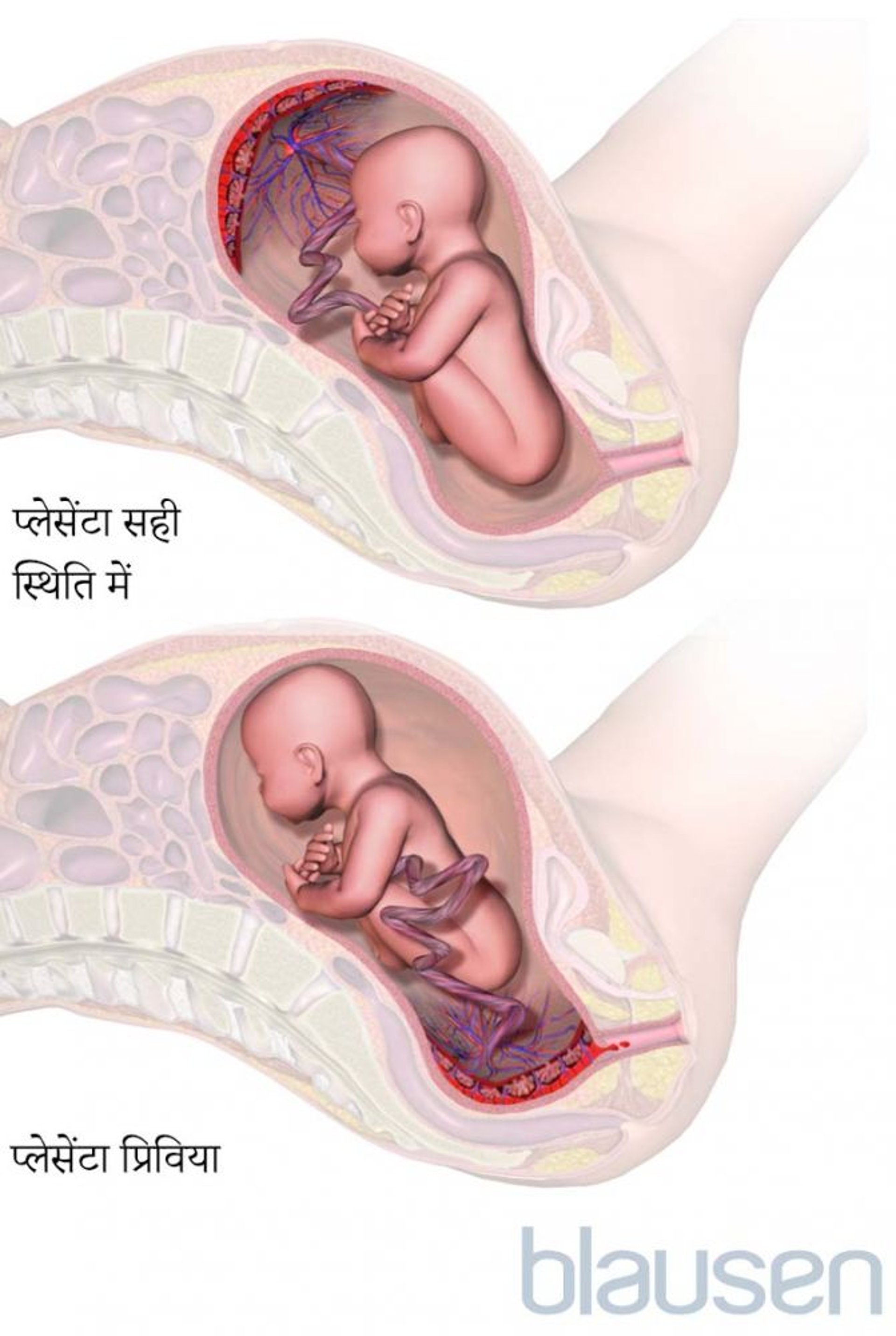 प्लेसेंटा प्रिविया