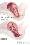 前置胎盤