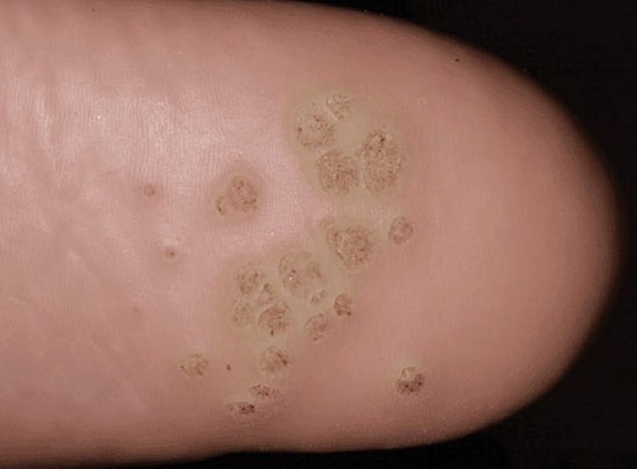 Plantar Warts