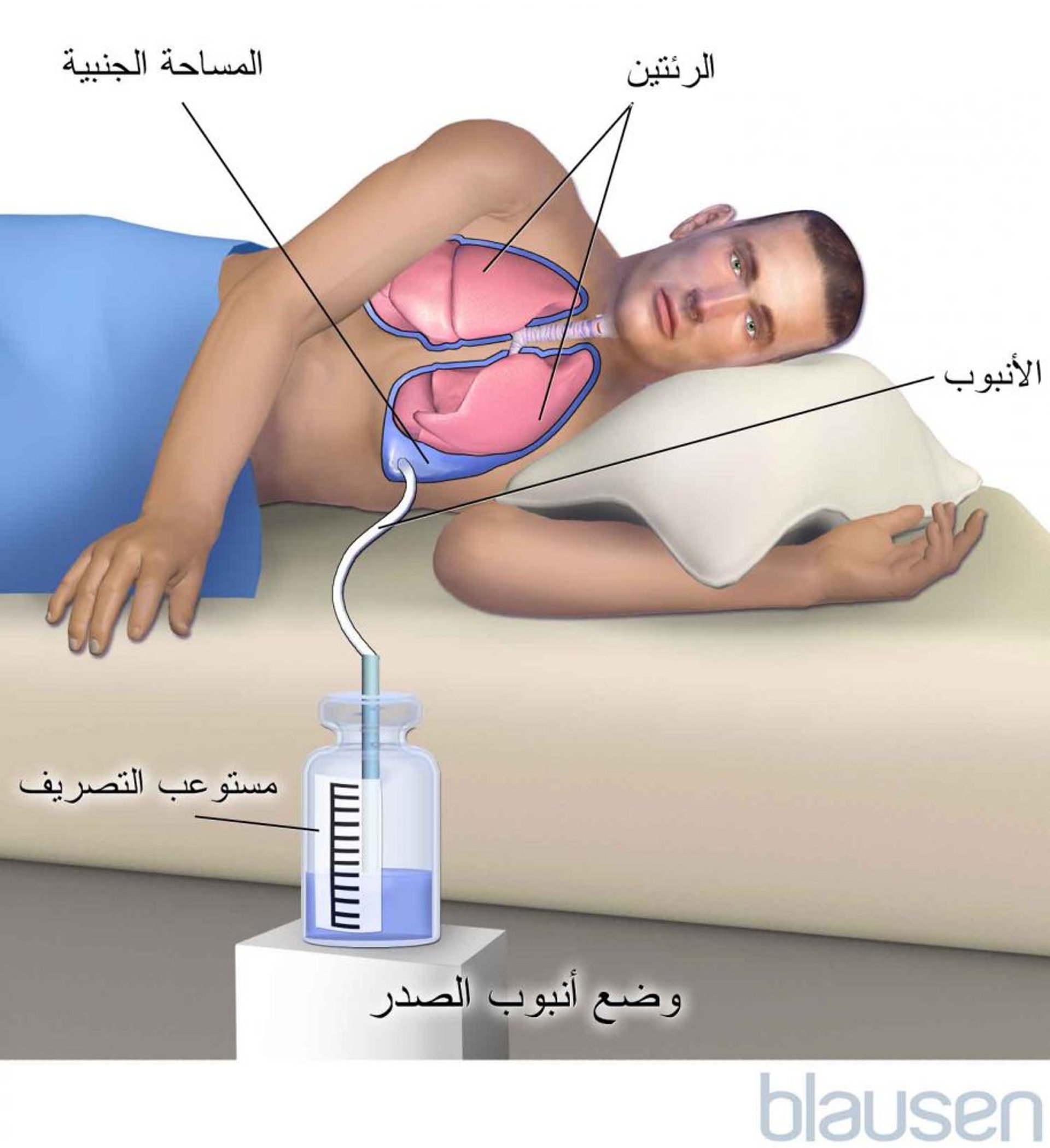 الالتصاق الجنبي