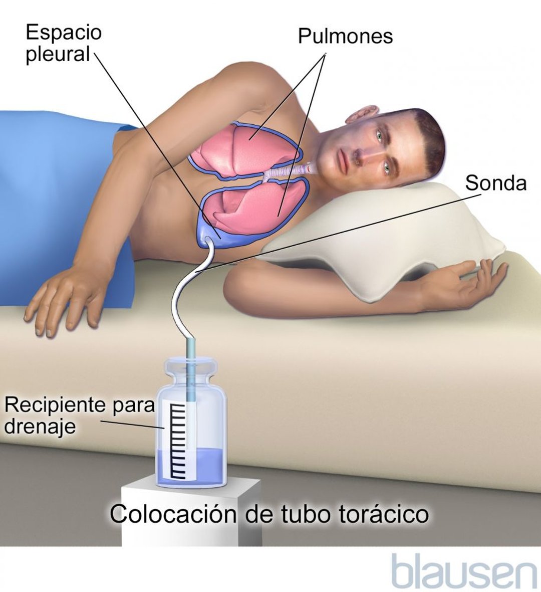 Derrame pleural - Trastornos del pulmón y las vías respiratorias ...