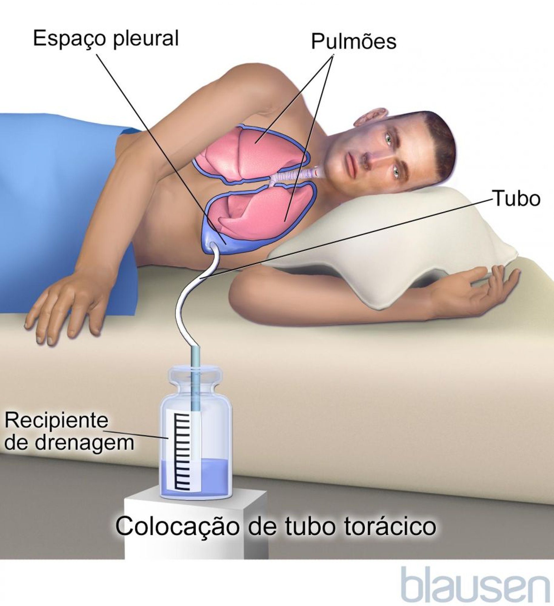 Pleurodese