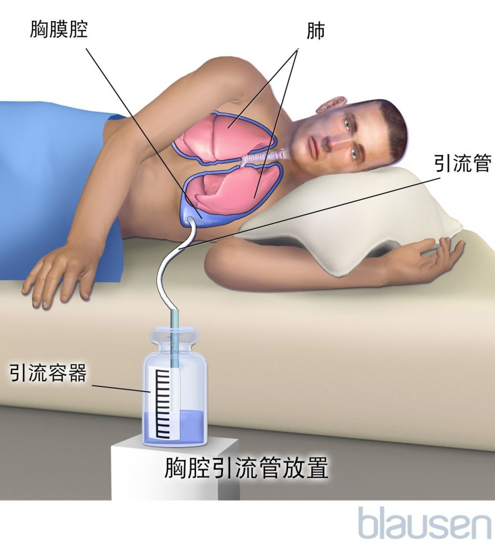 胸膜固定术