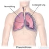 Pneumothorax
