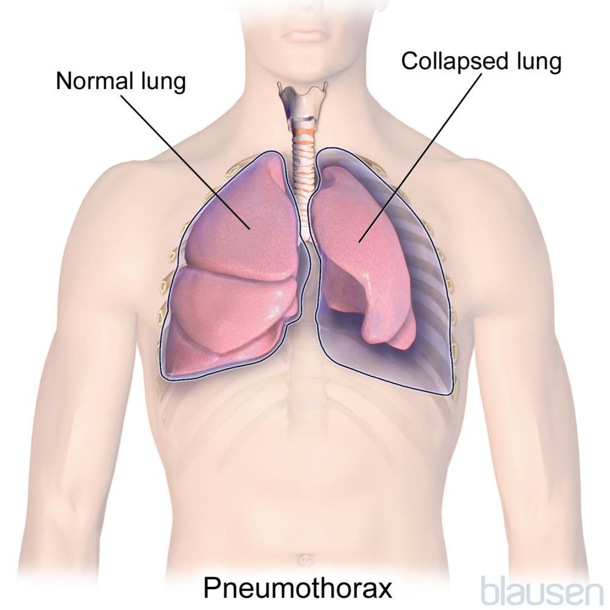 Pneumothorax