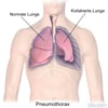Pneumothorax