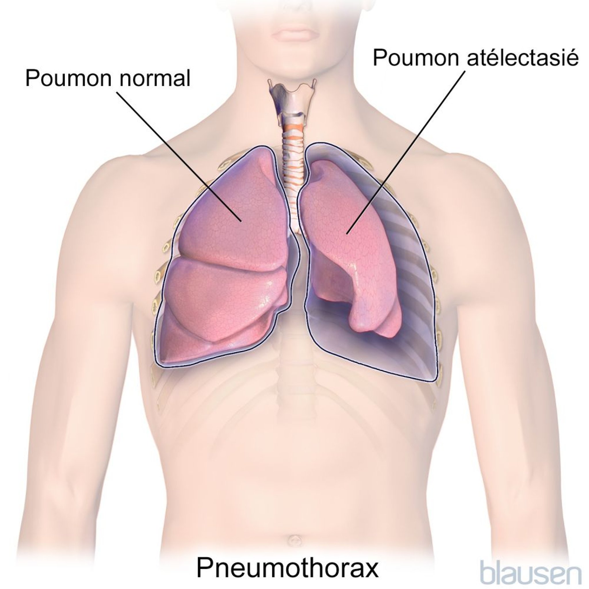 Pneumothorax