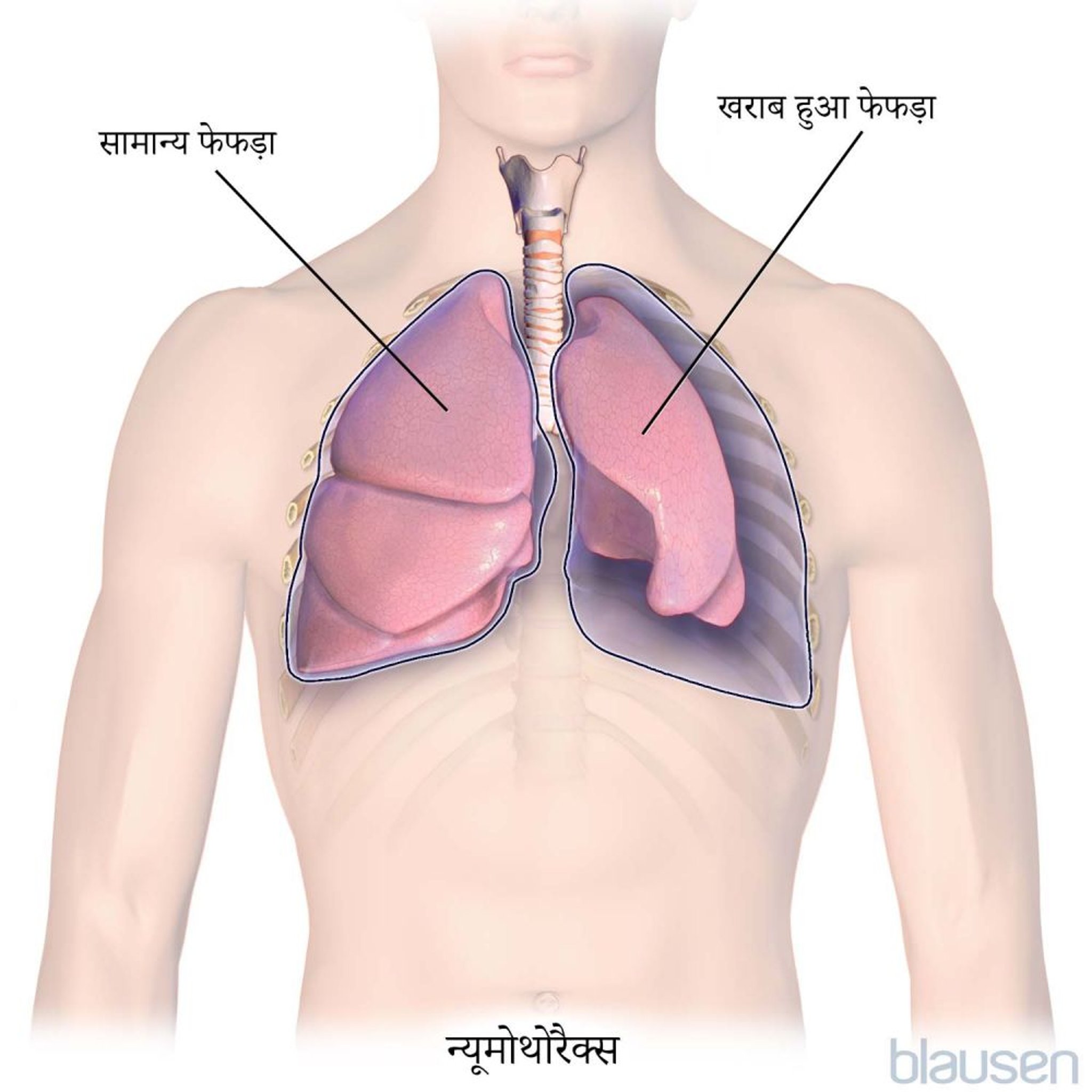 न्यूमोथोरैक्स