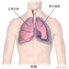 気胸