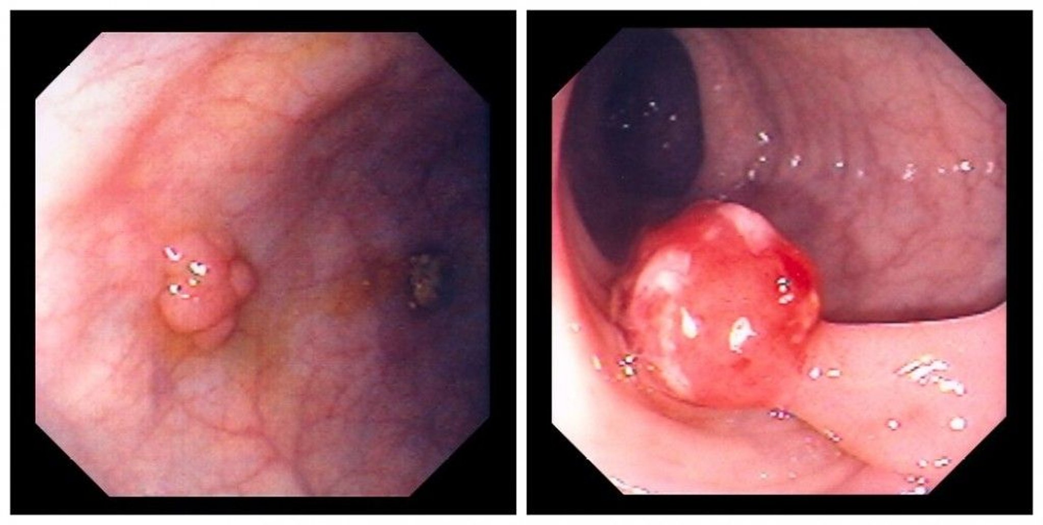 Polyps