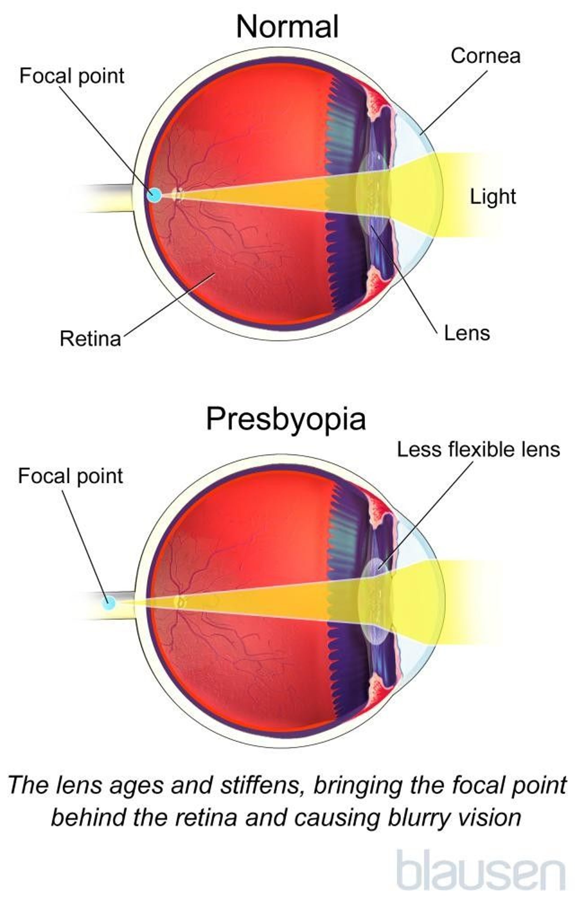 Presbyopia