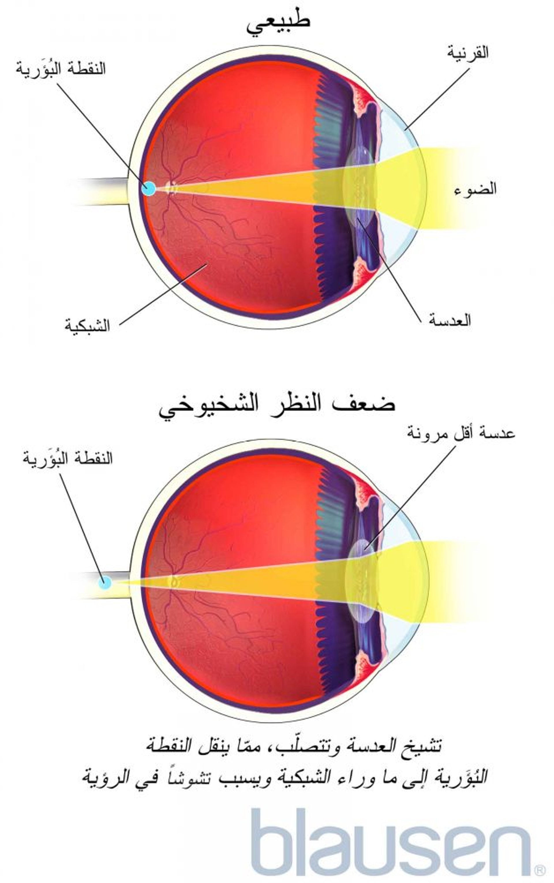 مد البصر الشيخوخي