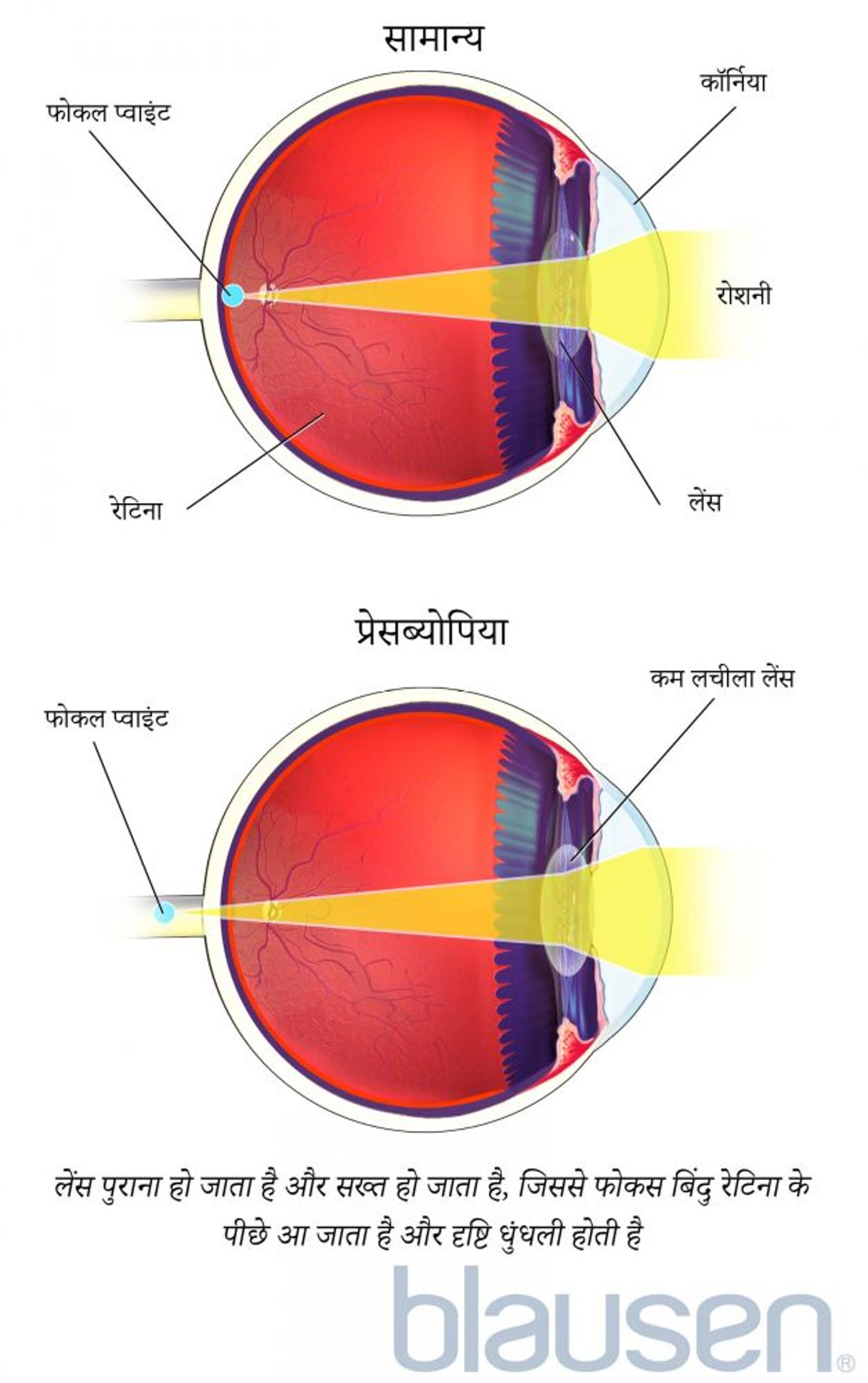 प्रेसब्योपिया