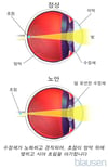 노안