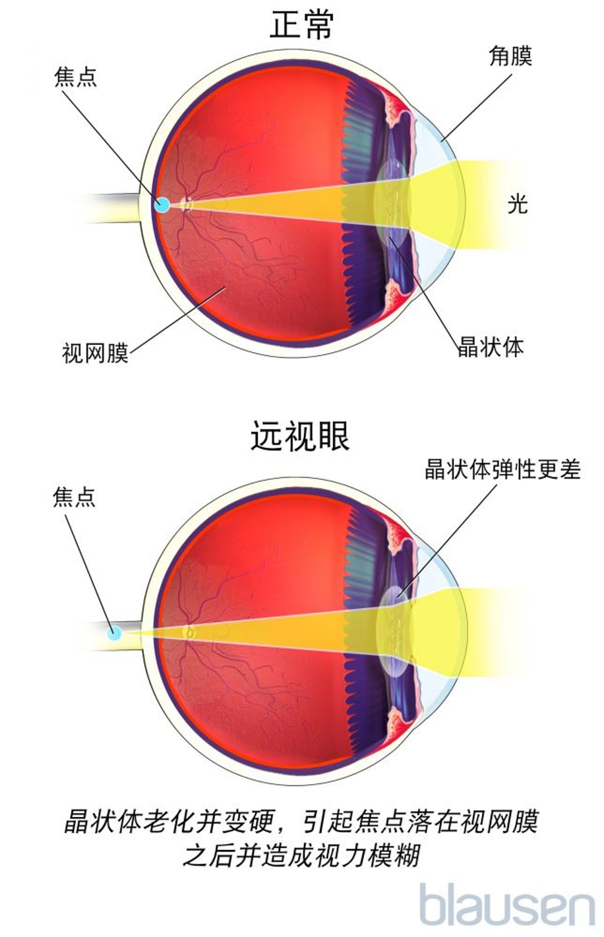 老花眼