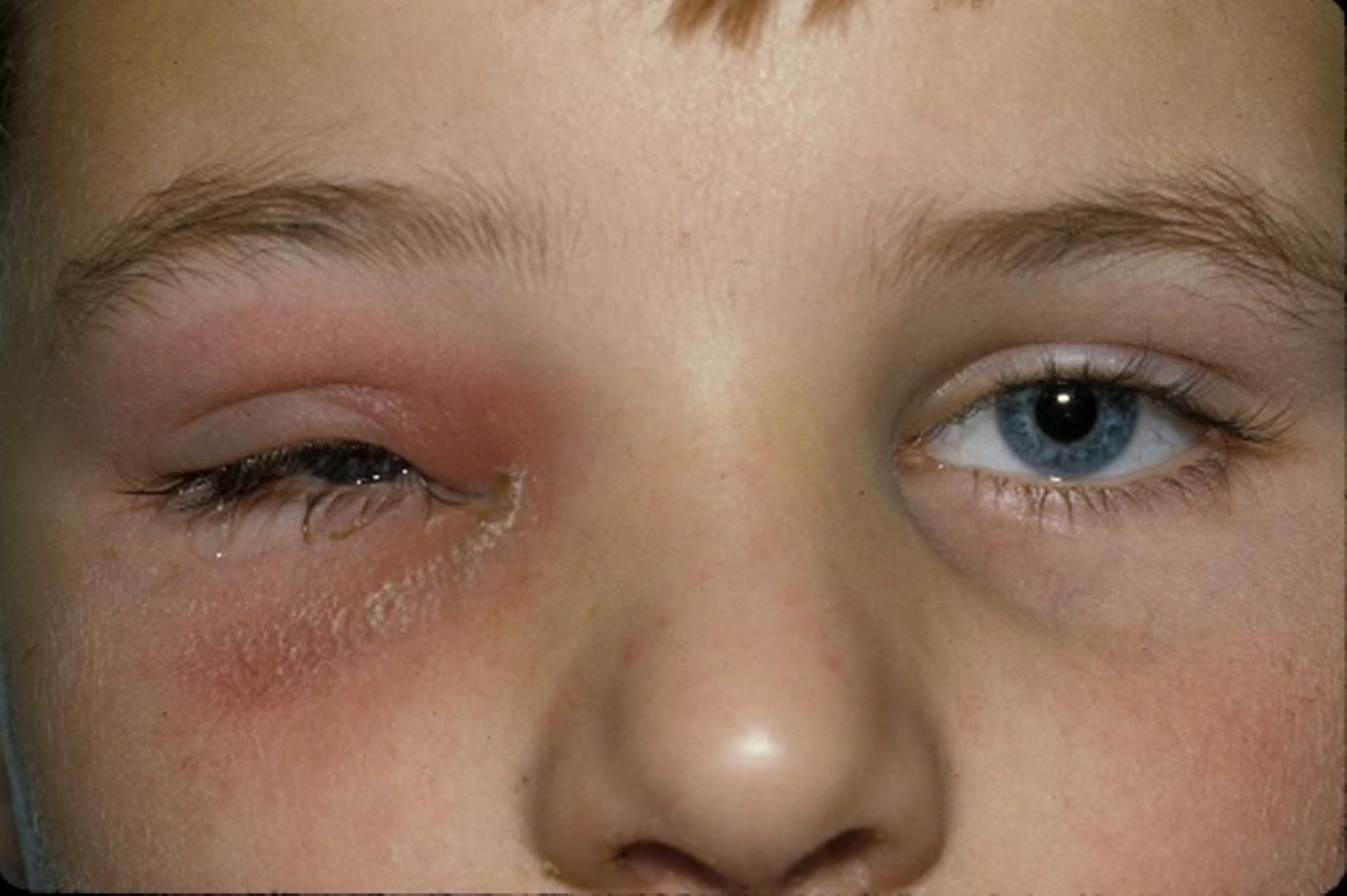 眼窩隔膜前蜂窩織炎