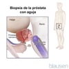 Biopsia por punción de la prostata (transrectal)