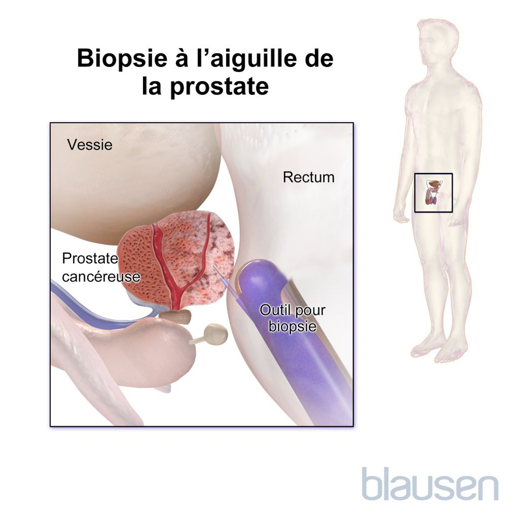 Biopsie de la prostate à l’aiguille (transrectale)