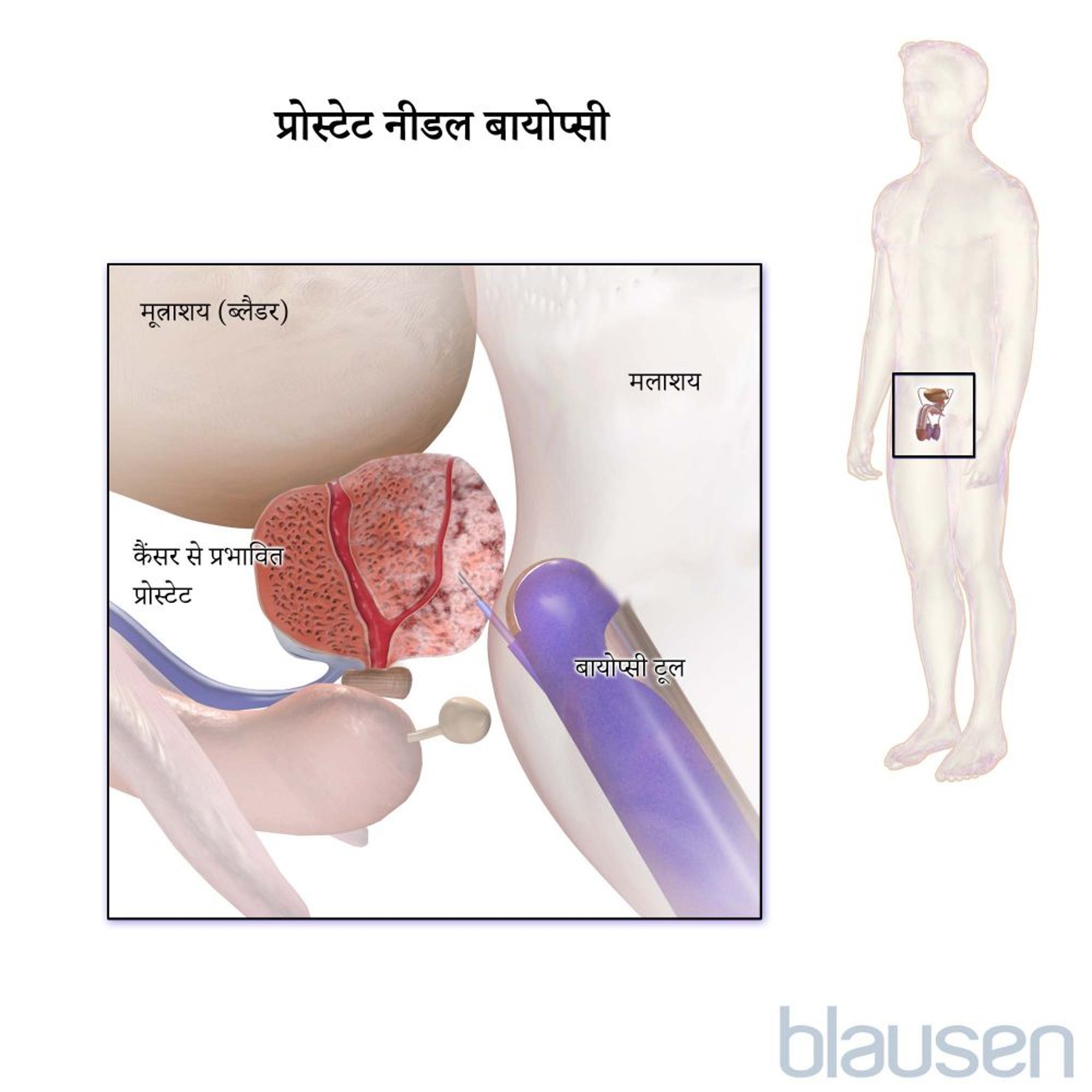 प्रोस्टेट की नीडल बायोप्सी (ट्रांसरेक्टल)