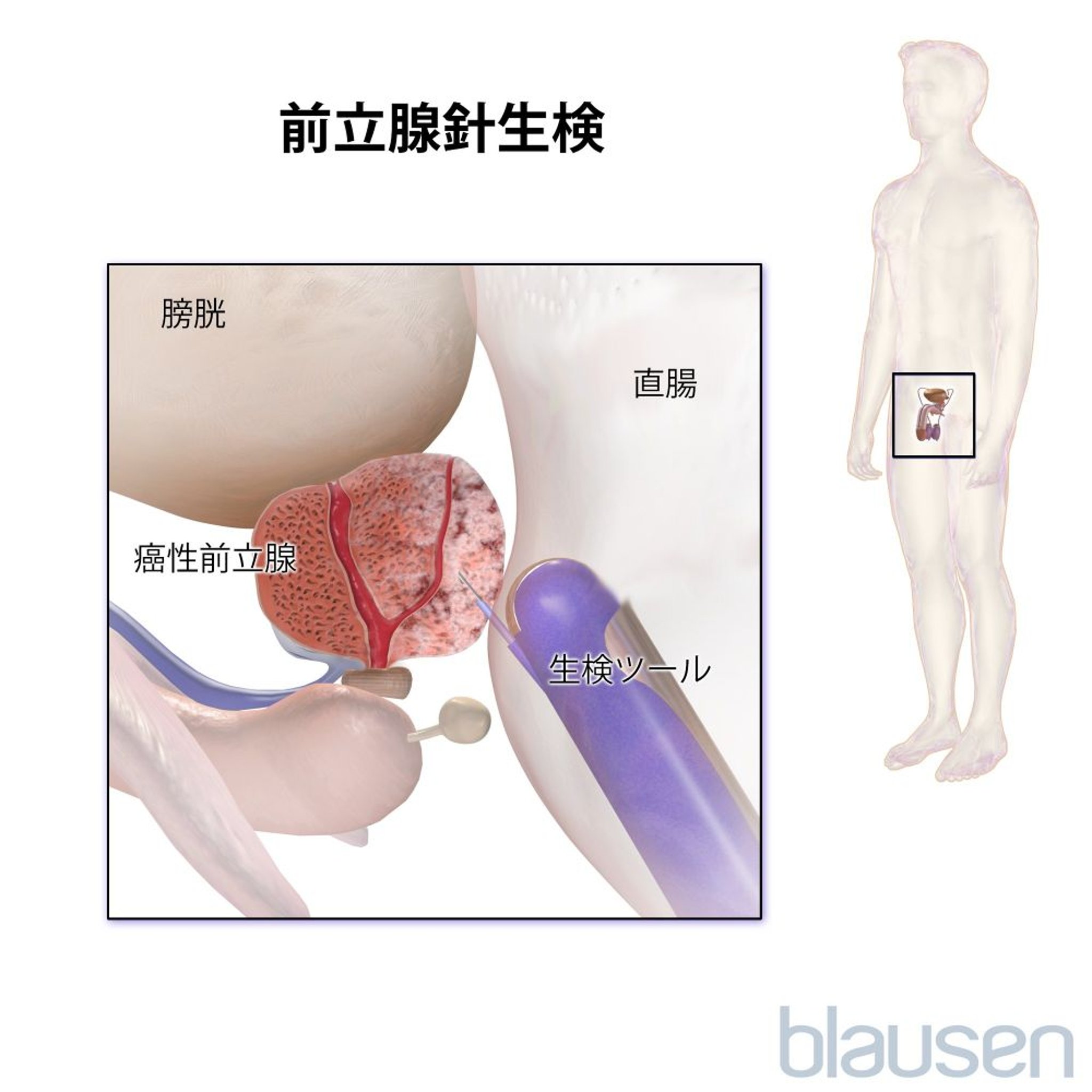 前立腺の針生検（経直腸的）
