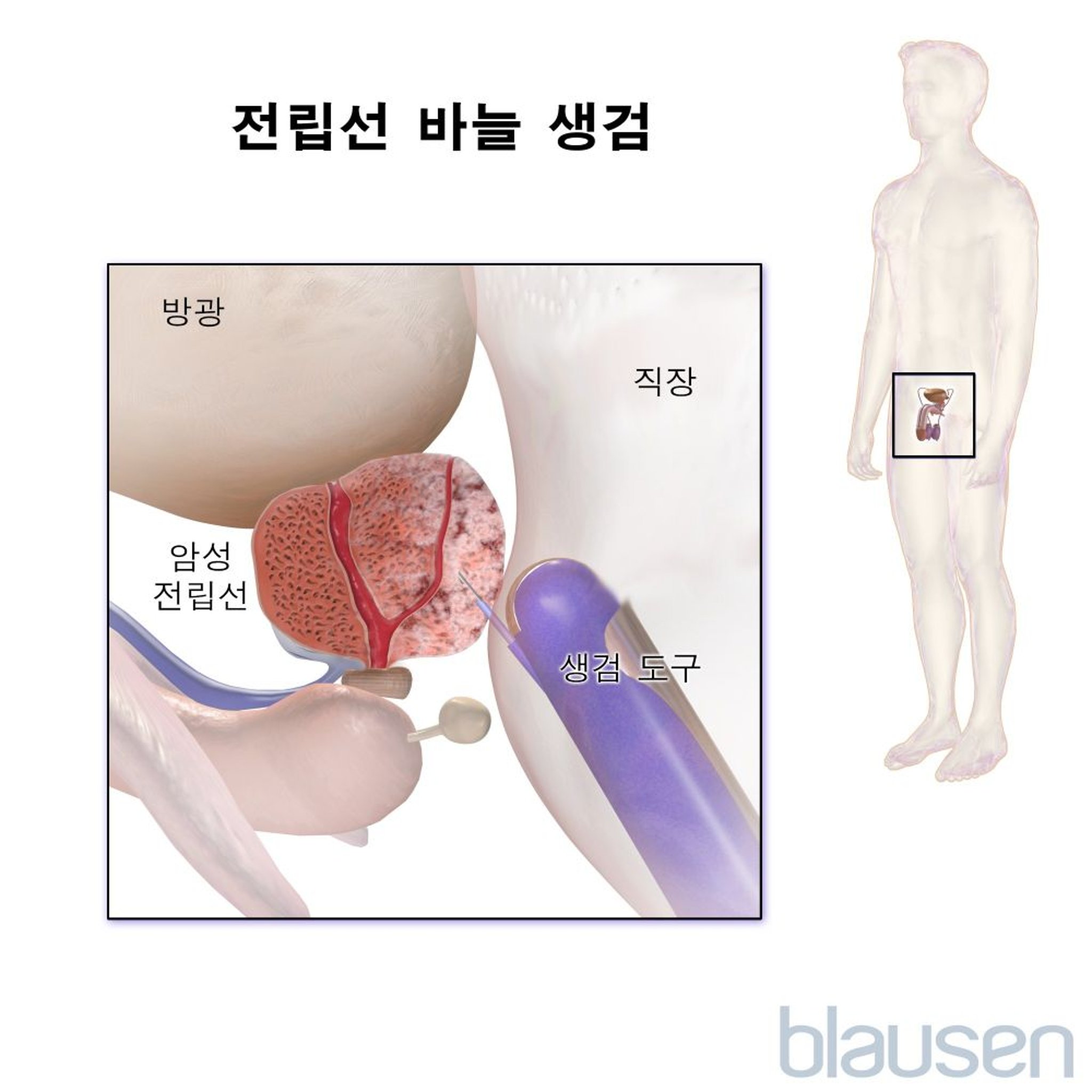 전립선의 바늘 생검(경직장)