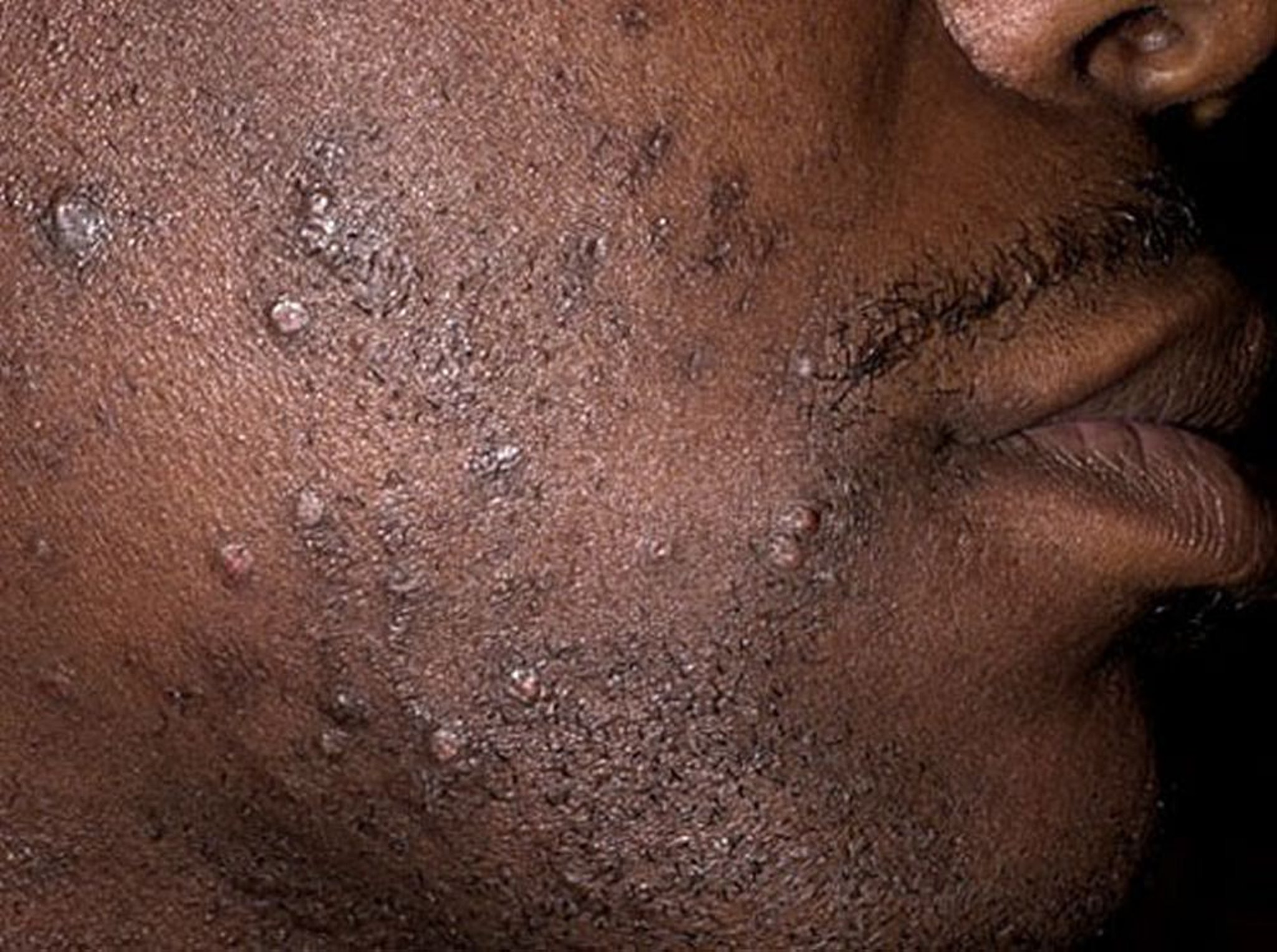 Poils incarnés de la barbe (pseudofolliculite de barbe)