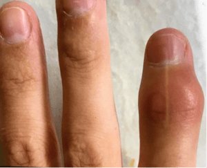 Swelling of a Distal Interphalangeal Joint