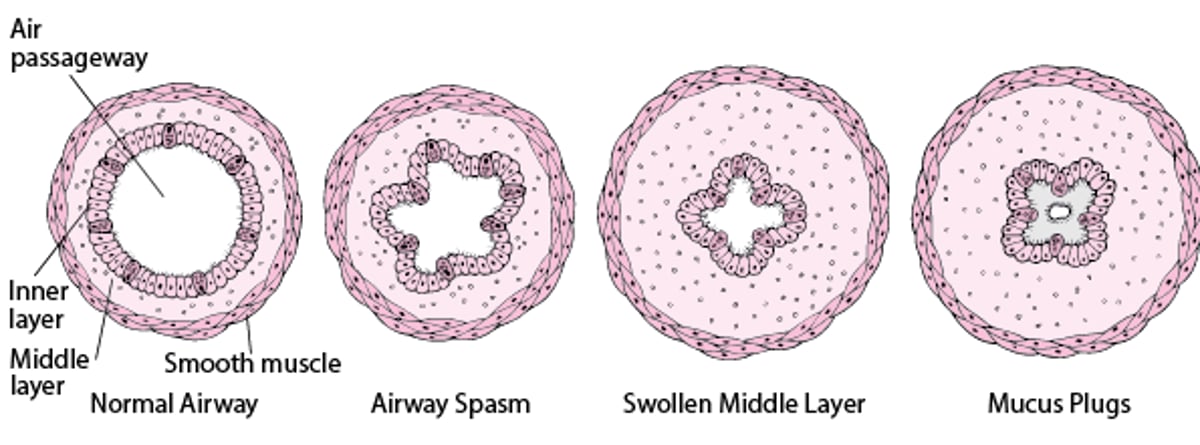 How Airways Narrow