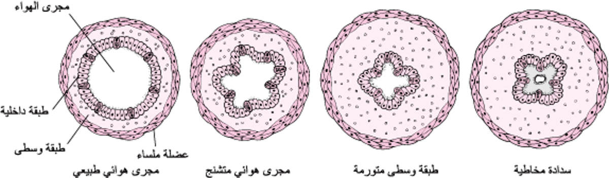 كيف تتضيَّقُ المسالك التَّنفُّسيَّة