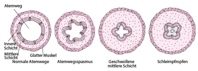 So verengen sich die Atemwege