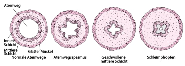 ImageSo verengen sich die AtemwegeMSD Manual Ausgabe für Patienten