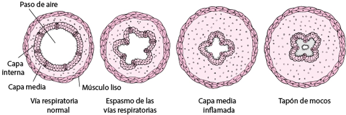 Cómo se estrechan las vías respiratorias