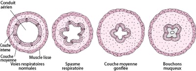 Comment les voies respiratoires se rétrécissent