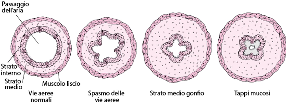 Restringimento delle vie aeree