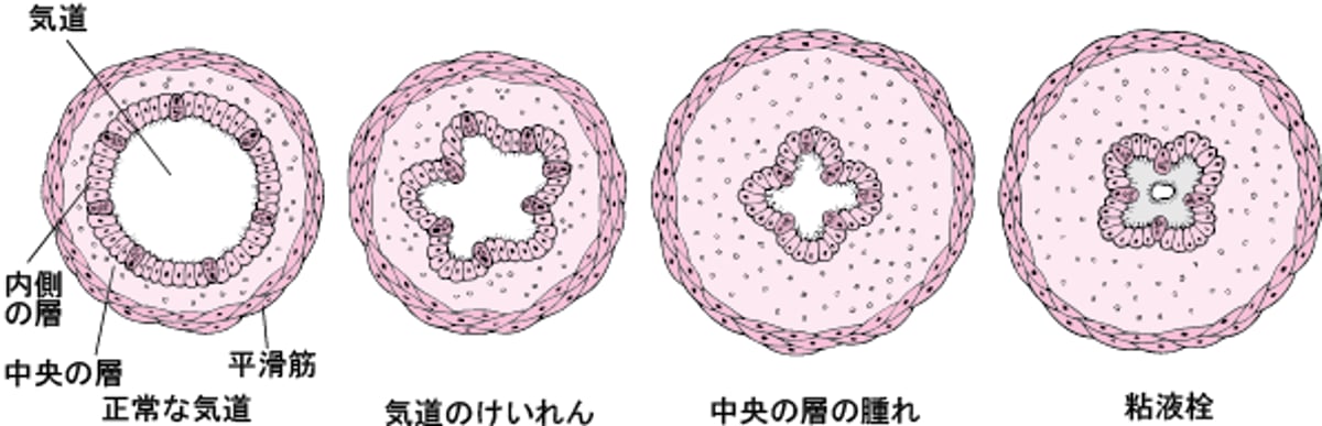 気道が狭くなるメカニズム