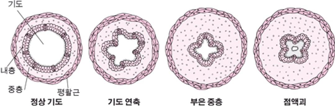 기도가 협착되는 방식