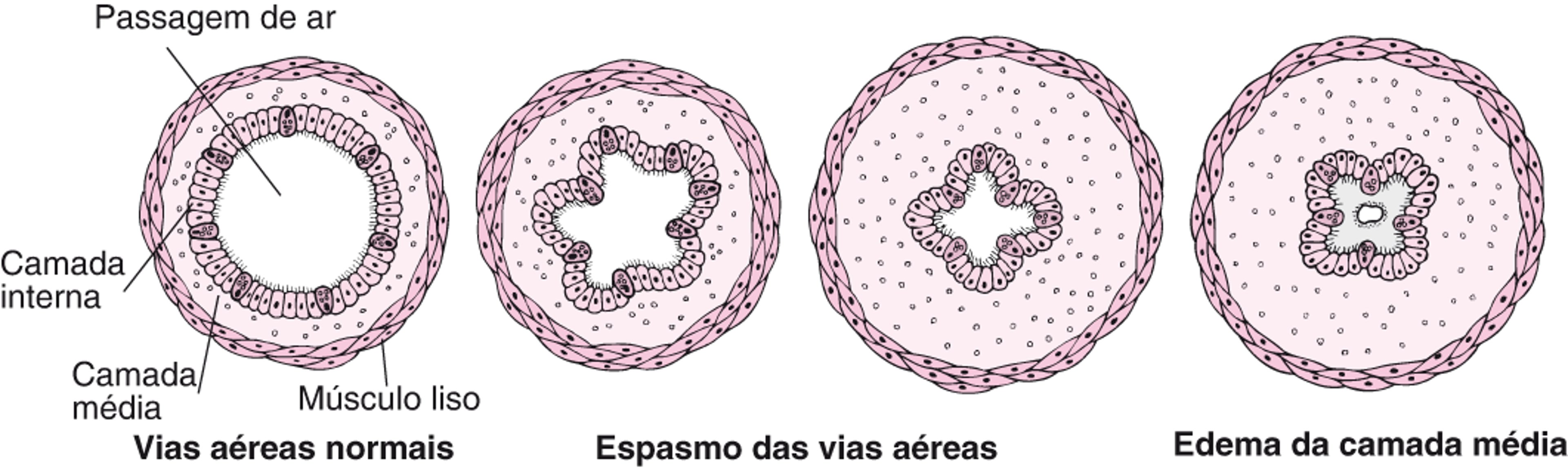 Como as vias aéreas se estreitam