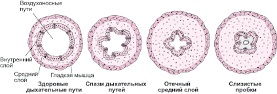 Как происходит сужение дыхательных путей