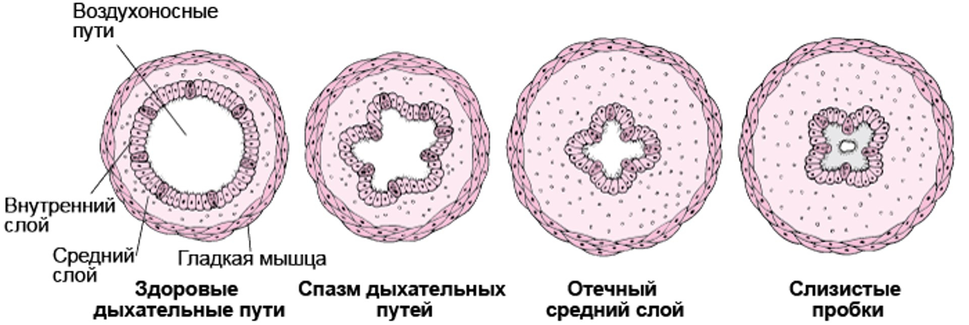 Как происходит сужение дыхательных путей